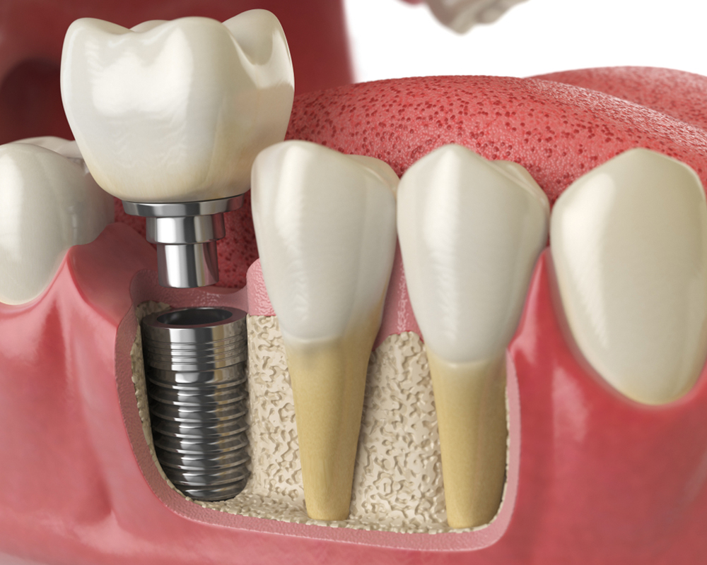 DENTAL IMPLANT